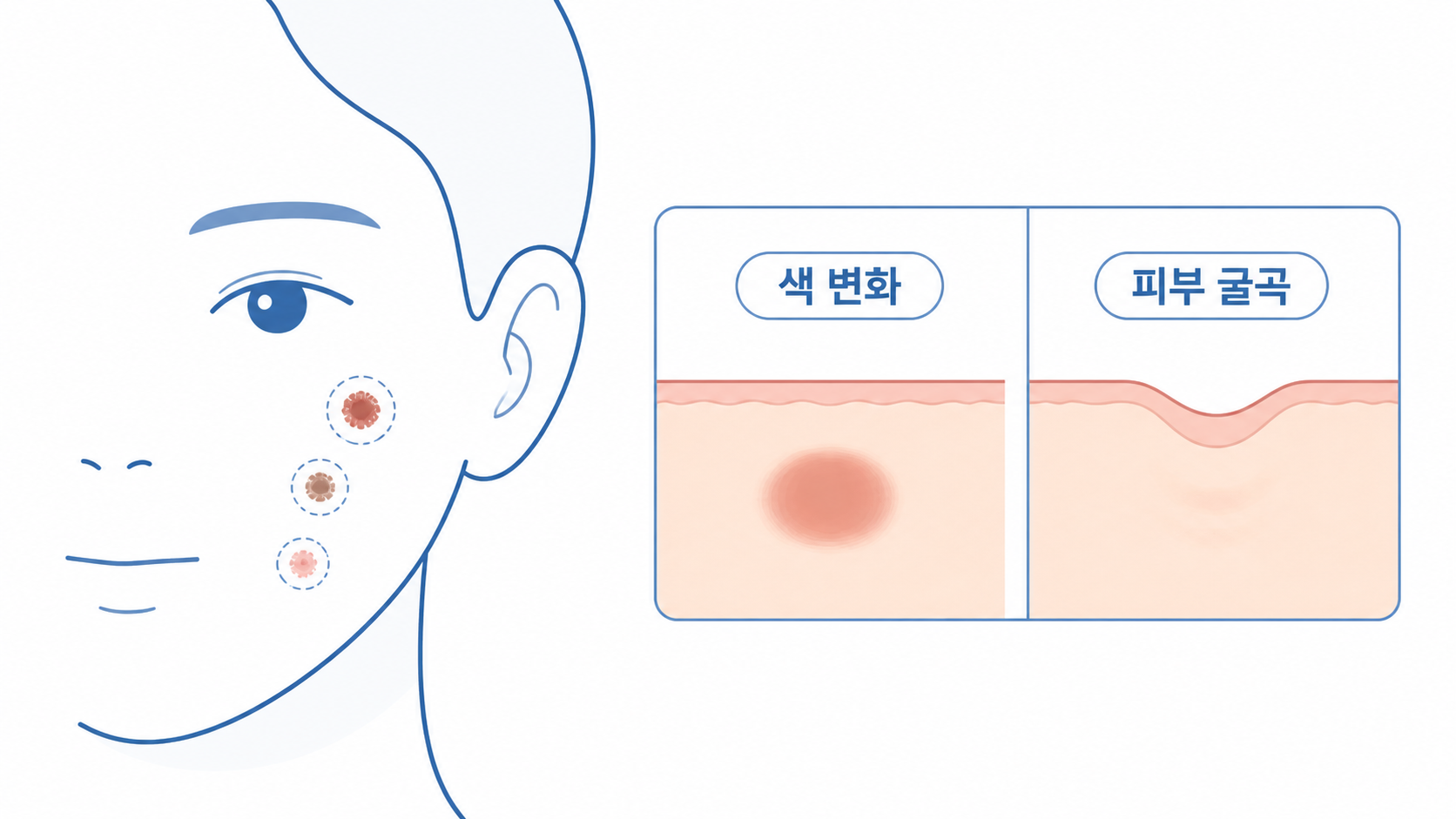 색 변화와 피부 굴곡을 체크하는 여드름 흔적 구분 일러스트