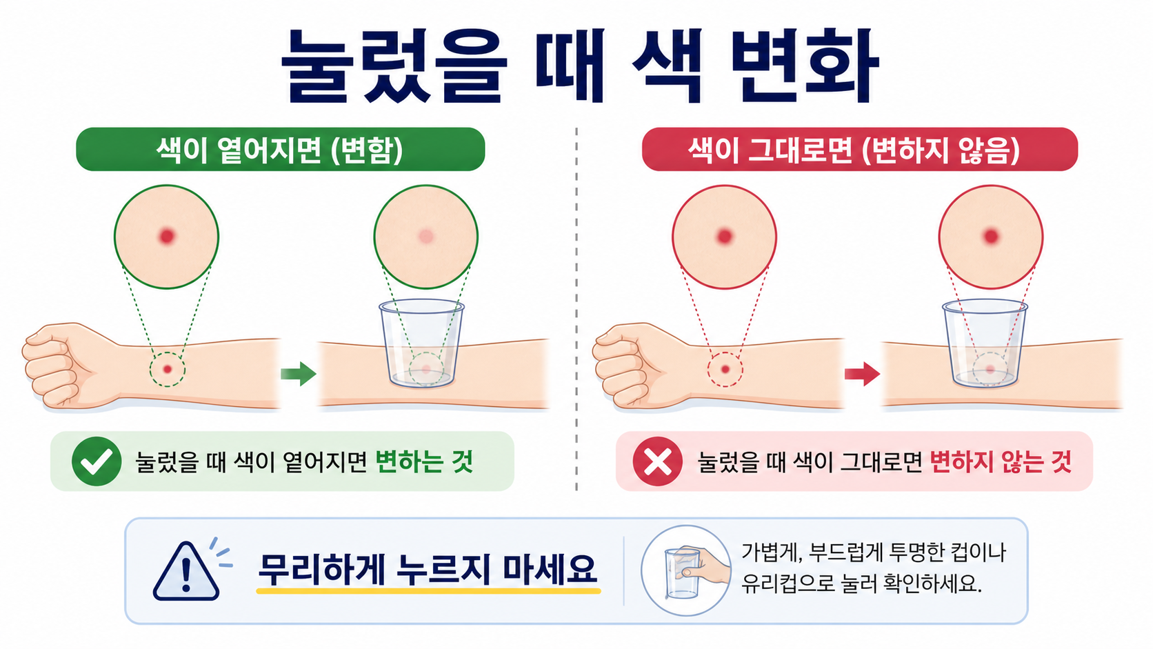 피부 반점을 투명한 컵으로 가볍게 관찰할 때 색 변화만 기록하라는 정보카드