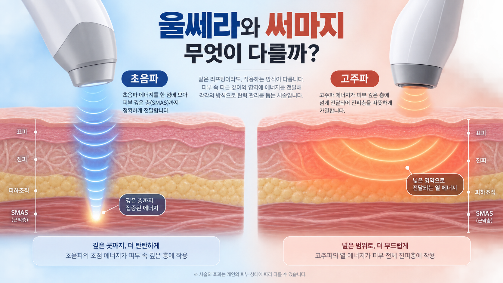울쎄라와 써마지의 초음파와 고주파 작동 방식을 비교한 한국어 정보카드